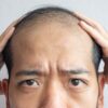 Why Bald Men Spend Middle Age Growing Hair On Their Backs