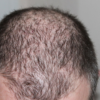 Baldness: How to Stop Hair Breakage Naturally – Version Weekly